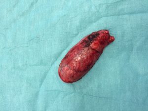 Gall bladder